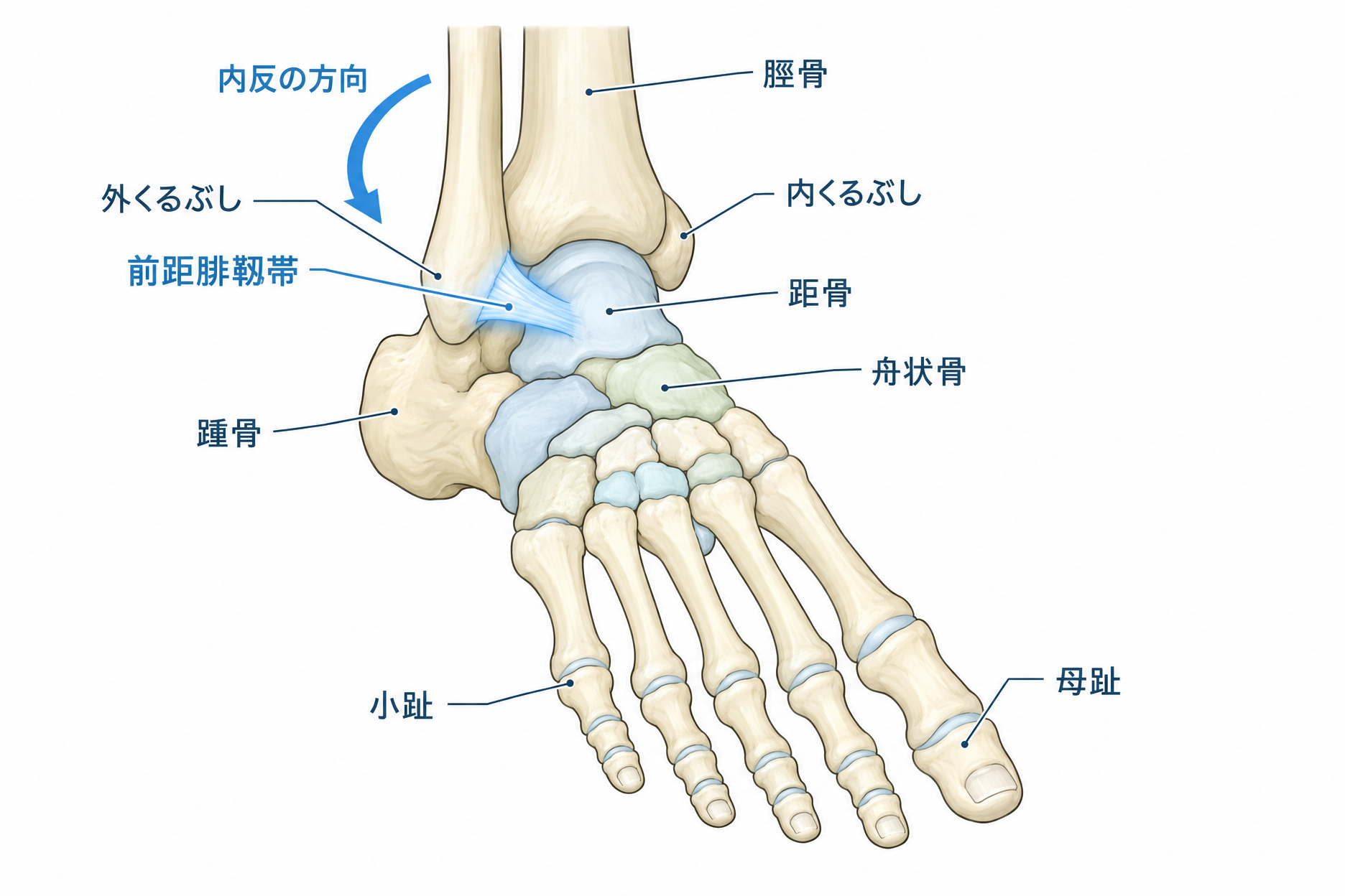 足関節を内側にひねったときに外くるぶし前方の前距腓靱帯が引き伸ばされる仕組みを示した解説図